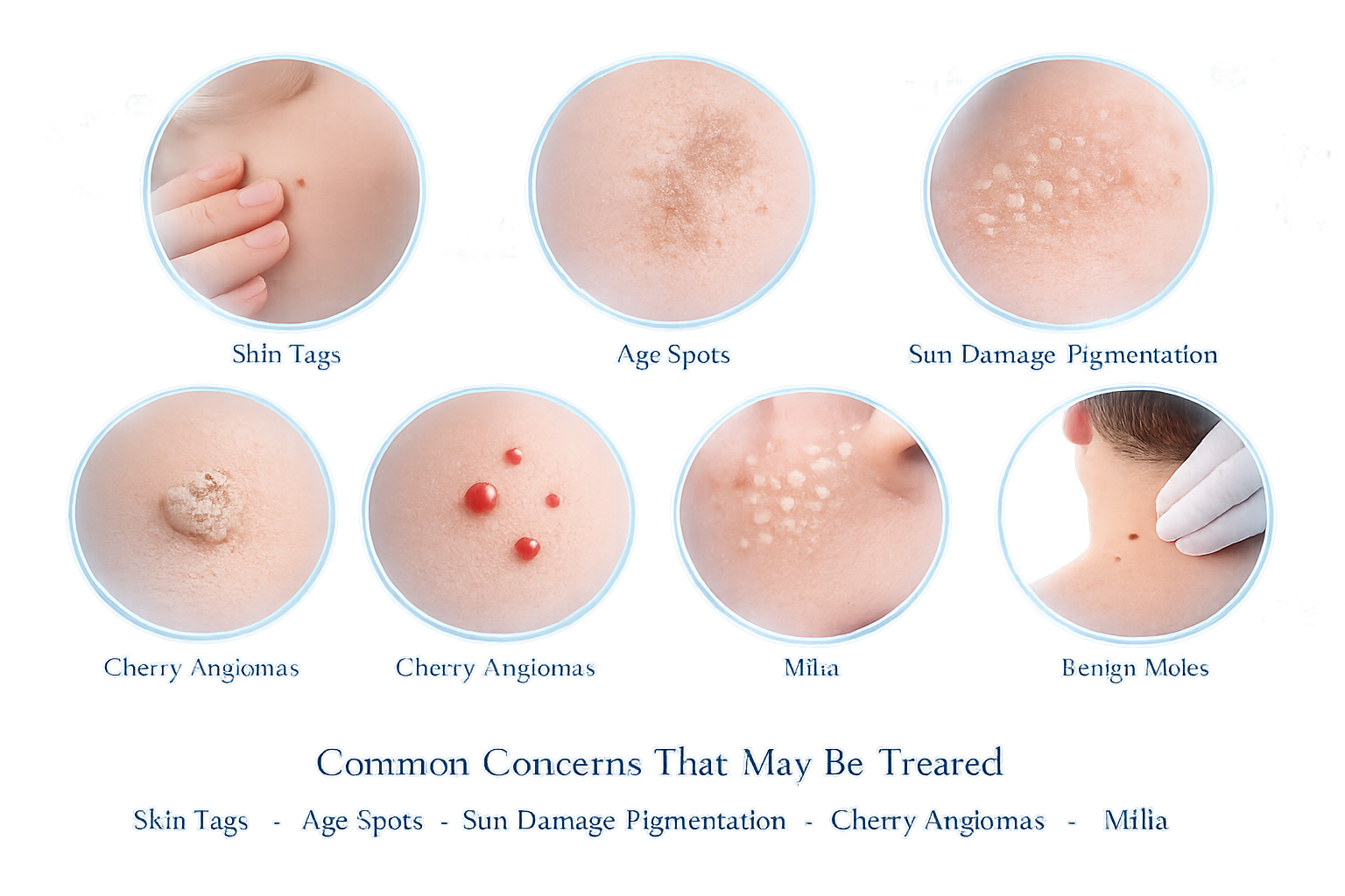 A close-up of skin texture with a small raised bump, softly lit to show detail and depth.